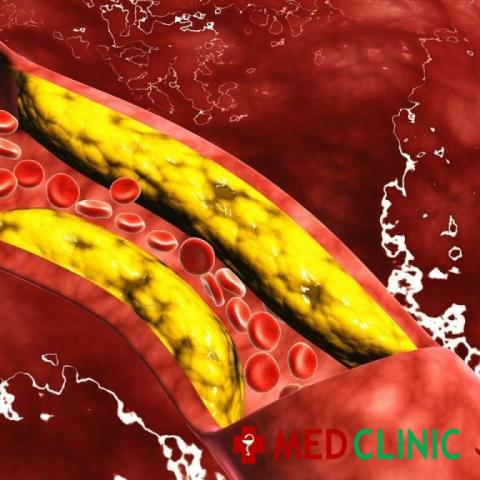 Гиперхолестеринемия: причины, симптомы, классификация, осложнения и методы лечения в «СМ-Клиника»